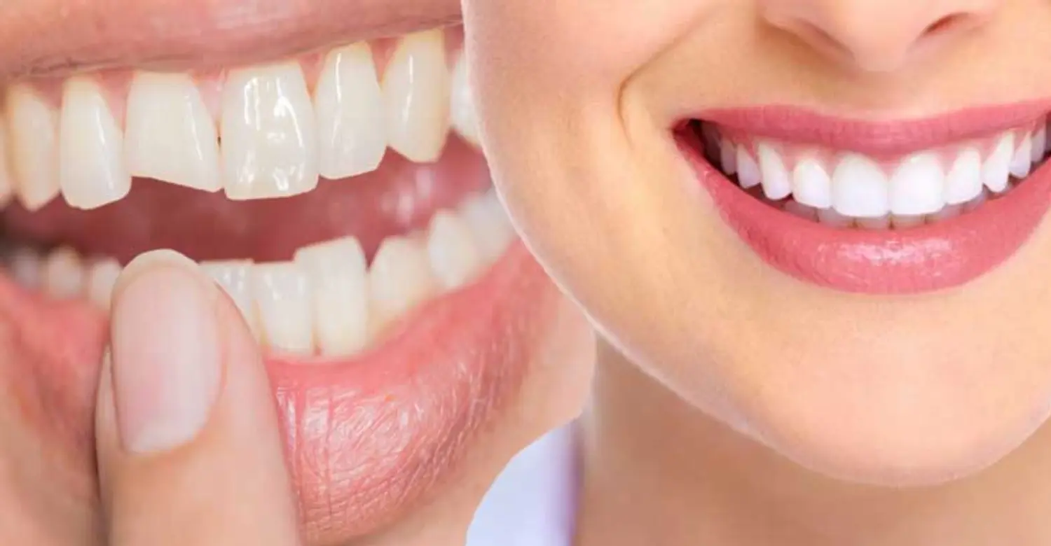 Dental Cosmetics in Turkey 2